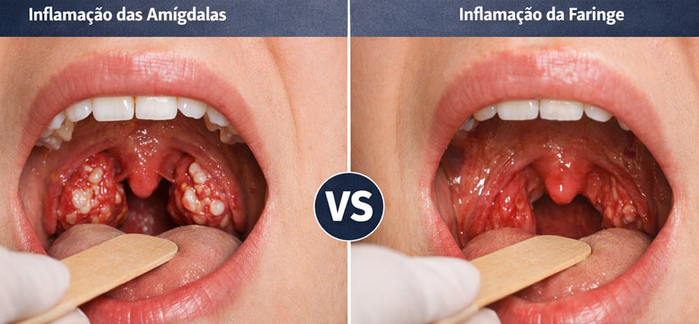 amigdalite versus faringite