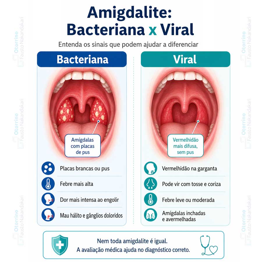 diferenças da amigdalite viral e bacteriana
