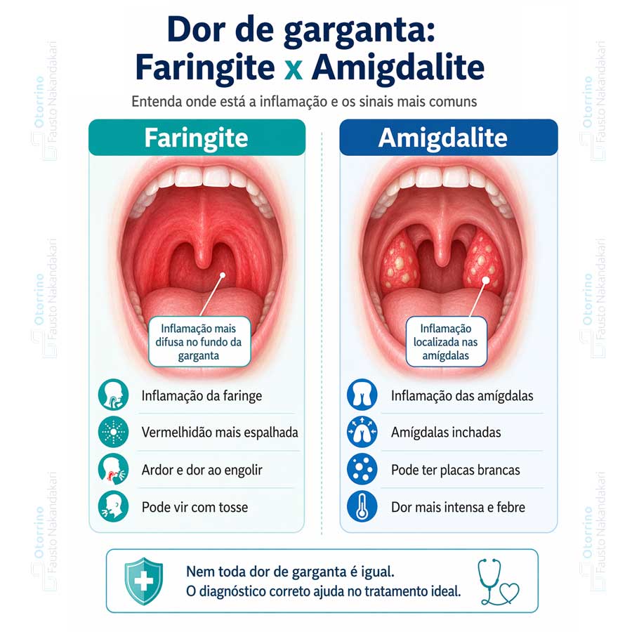 diferenças entre faringite e amigdalite