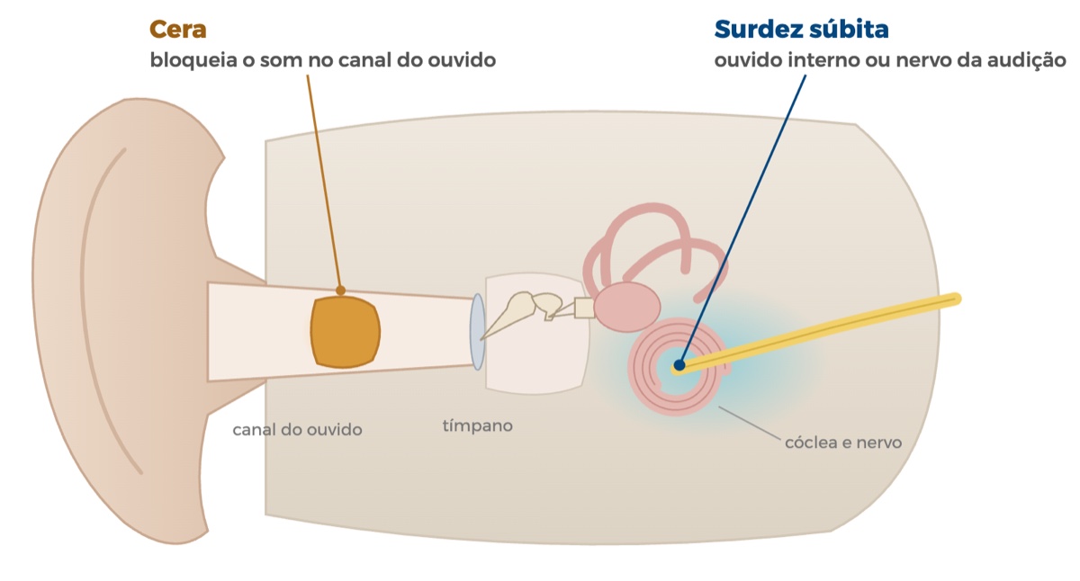 corte esquemático do ouvido: a cera bloqueia o canal do ouvido; a surdez súbita está no ouvido interno ou no nervo da audição