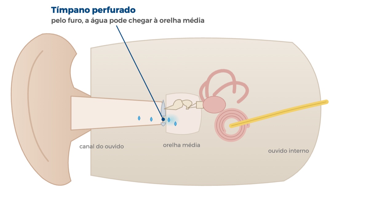 Tímpano perfurado: sintomas, se tem cura e o que fazer enquanto fecha