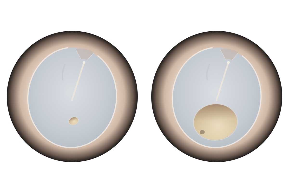 tímpano perfurado: ilustração de dois tímpanos vistos pelo canal do ouvido, com uma perfuração pequena à esquerda e uma grande à direita